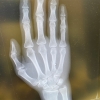 骨折した手のレントゲン